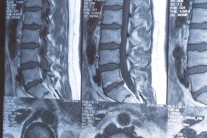 Top-Rated Disc Bulge and Herniation Treatment in Kansas City at Dohrmann Chiropractic