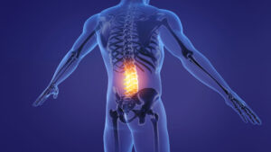 Top-rated Disc Bulge & Herniation Treatment in Kansas City at Dohrmann Chiropractic