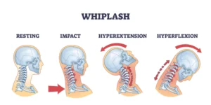 Whiplash Warning Signs Every Kansas City Driver Should Know