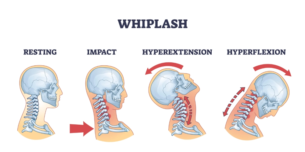 Whiplash Warning Signs Every Kansas City Driver Should Know