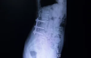 Can Spinal Decompression Help After Failed Back Surgery?