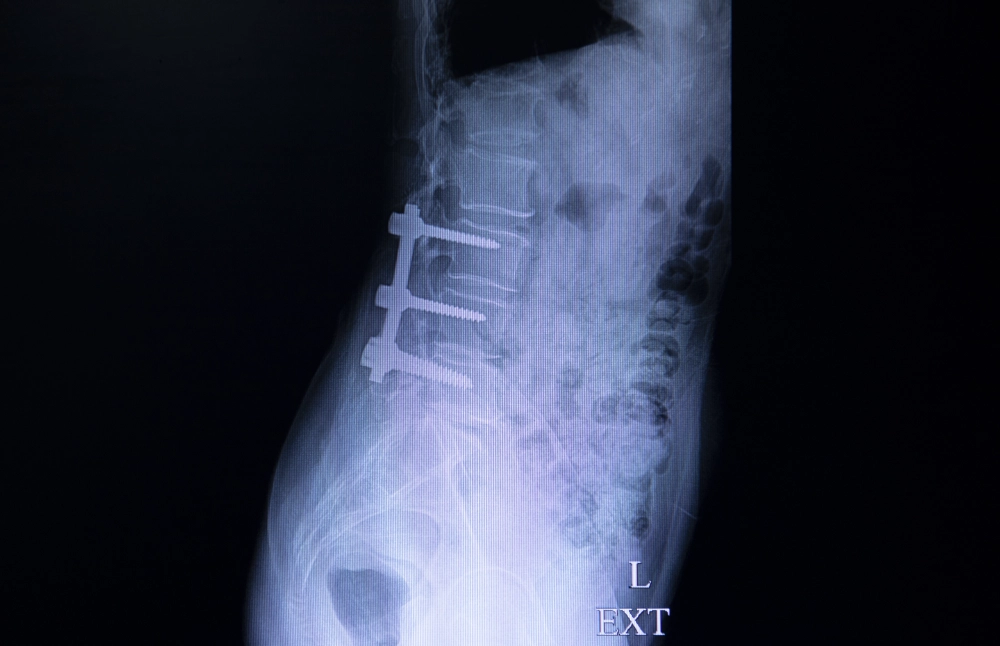Can Spinal Decompression Help After Failed Back Surgery?